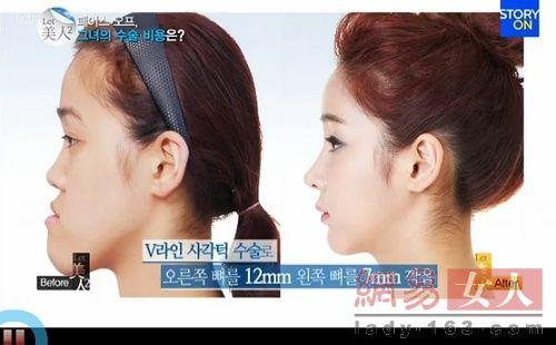 丑女變靚妹！韓國(guó)整容節(jié)目爆紅