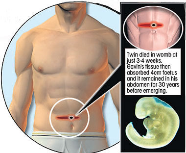 如電影《異形》再現(xiàn) 英男子腹部驚迸寄生胎
