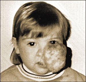 “腫瘤女孩”19次手術(shù)除瘤獲意中人