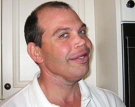 英國(guó)男子接受“變臉”手術(shù) 肋骨臀骨植入面部