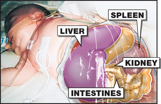 英男嬰患罕見癌癥 需“掏空內(nèi)臟”治癌