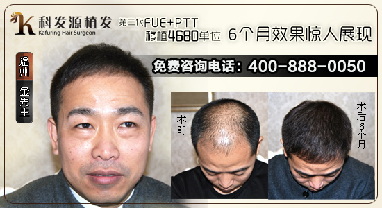 植發(fā)效果怎么樣 植發(fā)效果評估