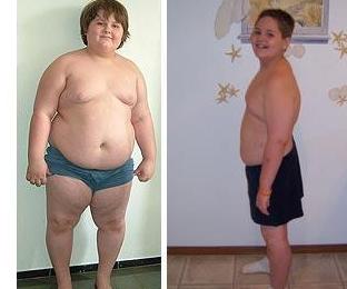 減肥手術(shù)最小患者:美國10歲男孩“切胃”救命